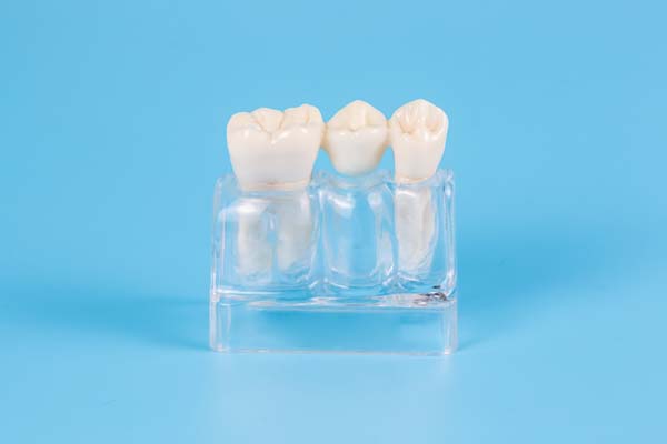 When A Dental Bridge May Be Recommended