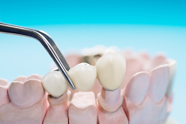 Dental Bridges Can Replace Missing Teeth