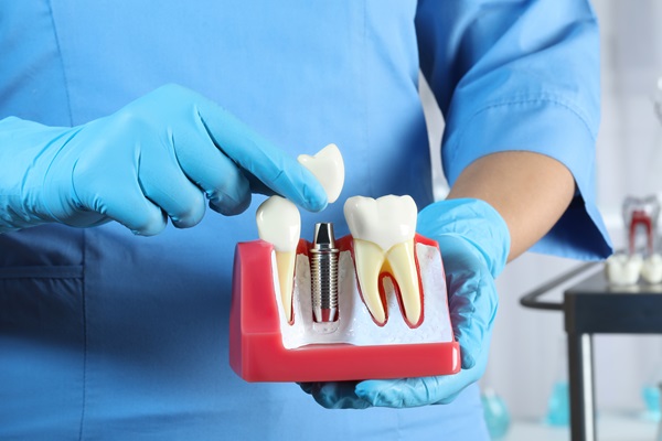 A Guide To The Dental Implant Restoration Process