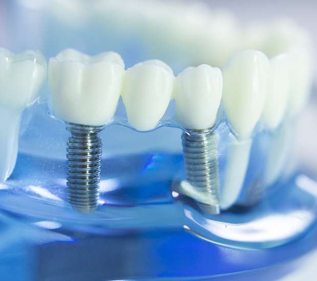 North Arlington Dental Implants